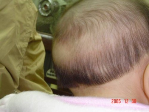 Điều trị triệu chứng tóc rụng hình vành khăn ở trẻ